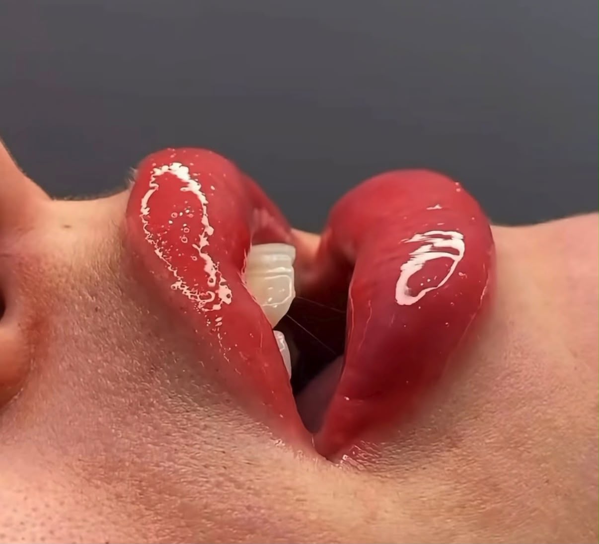 Hidrolips